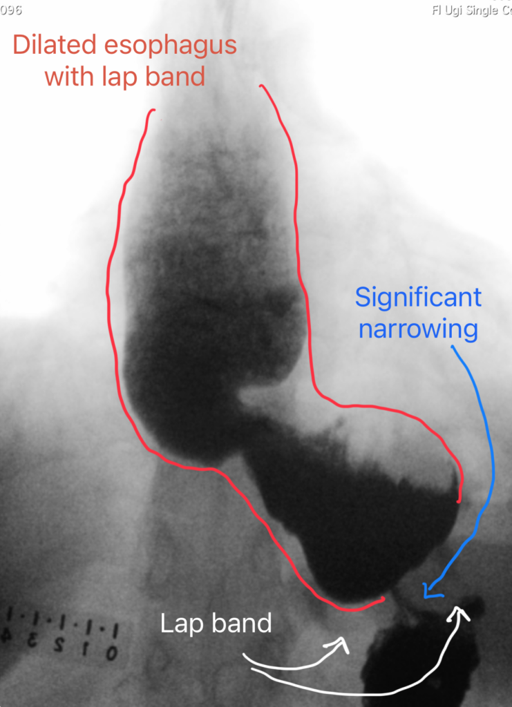 Dilated Esophagus-A Common Complication of Lap Band